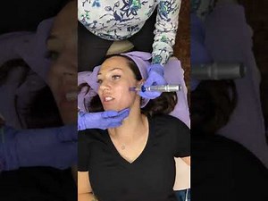 Microneedling Procedure & Tutorial