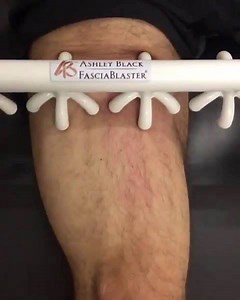 Both men and women are using the #FasciaBlaster for SO many reasons! Our peer-reviewed and published study shows that the FasciaBlaster tools resulted in: ✨ a reduction of fat ✨ increased resting metabolic rate ✨ decrease in the appearance of cellulite ✨ decrease of inflammation As you see in this video, the FasciaBlaster claws glide through the tissue, not roll over it, which puts our tools in a class of their own. Learn more about the benefits of the FasciaBlaster by reading our study here: ht