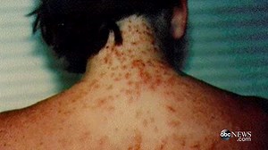Sea Lice Outbreaks on Rise in Gulf Coast Beaches