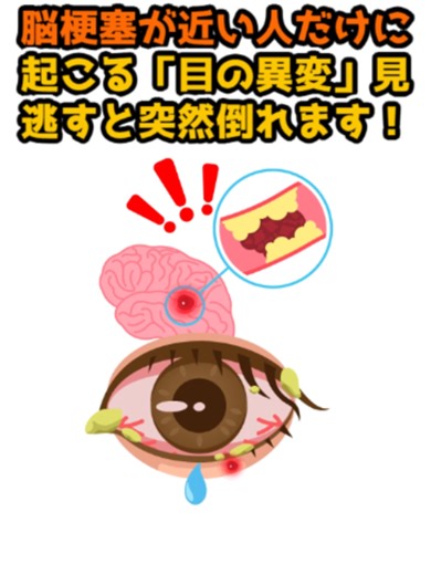 【９割が知らない】 脳梗塞が近い人だけに起こる「目の異変」見逃すと突然倒れます！ #目 #日本 #脳梗塞 #健康 #fyp #雑学 #不眠 #ストレス #tiktokviral #fyp #血管 #足 #バイラル #50 #abczyx #xyzabc #foryour #ほくろ