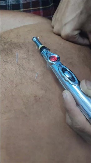 needling for shoulder pain || Dr Pankaj beniwal || #shoulderpainrelief #electrotherapy