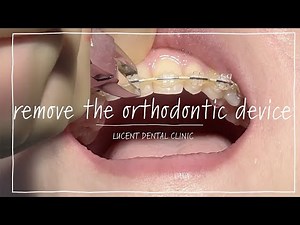 【人生が変わる!?】遂に、矯正装置を外します！【患者様へのお得情報有り】