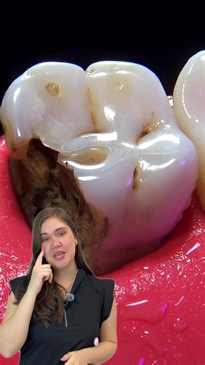 Endodoncia: Solución Efectiva para Caries Avanzadas