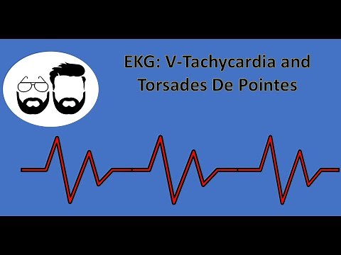 EKG Series: Ventricular Tachycardia (V-Tach) and Torsades De Pointes (Torsades)