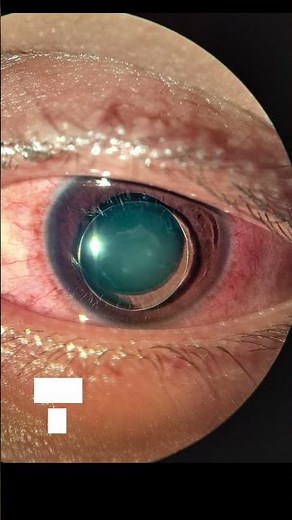 "Ectopia Lentis Explained in 30 Seconds 👁️ | #shorts #Ophthalmology"