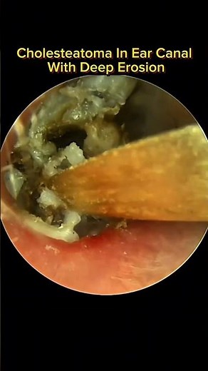 Cholesteatoma In Ear Canal With Deep Erosion