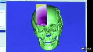 Malala Yousafzai's Surgery: Building a New Skull