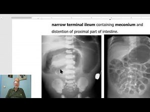 Paediatric surgery in Arabic 8 ( Meconium Ileus) , by Dr, Wahdan