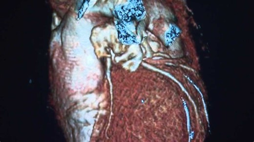 Many forms of vascular disease can be hard to diagnose | Here's why