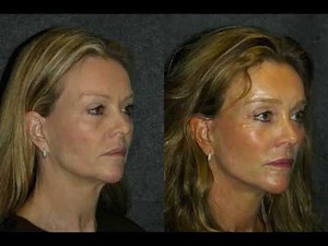 Quick Recovery Deep Plane Facelift Before and After on 52 Year Old Woman | #deepplanefacelift