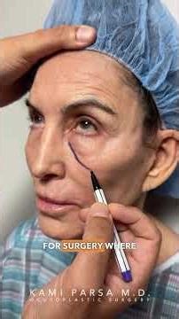 Treating FESTOONS (One of the Toughest Concerns to Treat) Dr. Kami Parsa