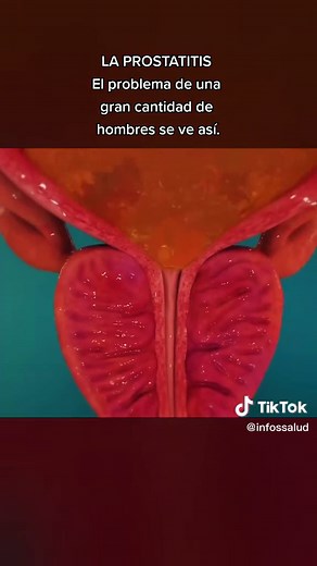 Prostatitis: Síntomas, Causas y Tratamiento
