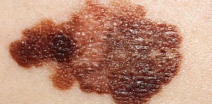 How cancer abducts your immune cells – and what we can do about it