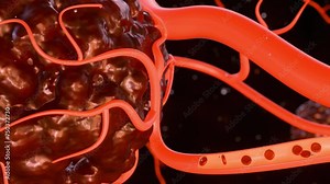 3d animation of cancer requires a blood supply to deliver the nutrients and oxygen it needs to grow and survive