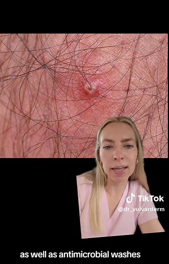 Folliculitis and Pseudofolliculitis: Understanding Vulvar Lumps and Bumps