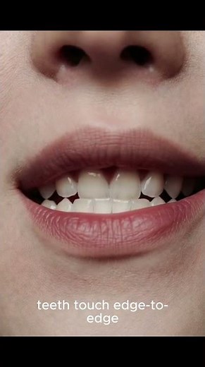 Overbite: Normal or Not?