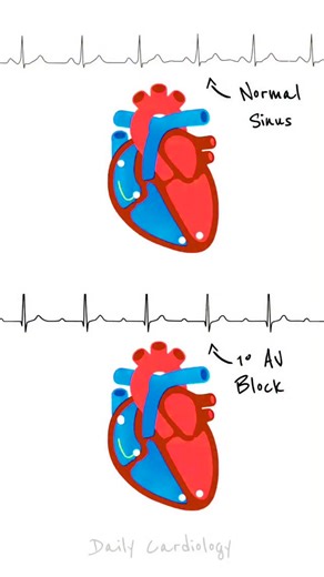 Abdallah Othman on Instagram: "AV Blocks – Progressive Conduction Failure: 1. First-Degree AV Block: Consistent delay at the AV node. Prolonged PR interval (>200 ms). Every impulse eventually reaches the ventricles. 2. Mobitz I (Wenckebach): Progressive PR interval lengthening until a P wave is blocked (a QRS is dropped). Typically at the AV node. Usually benign. 3. Mobitz II: Intermittent, sudden failure of conduction without preceding PR prolongation. Block typically infranodal (Bundle of His 