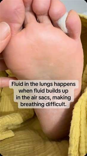 Irish School of Reflexology&W on Instagram: "Fluid in the lungs happens when fluid builds up in the air sacs, making breathing difficult. It’s often linked to heart problems, infections, or kidney issues, with symptoms such as breathlessness, coughing, and chest tightness. This can be a medical emergency, so prompt medical care is essential. Reflexology may be used alongside medical treatment to help support relaxation and ease some discomfort or tension. #Reflexology #WellnessTips #BreathingHea
