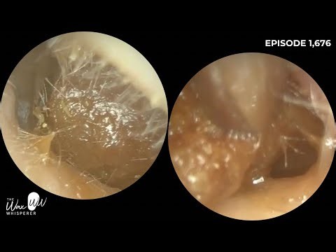 1,676 - Sticky Ear Wax Plugs Blocking the Ear Canal Removed | Endoscopic Procedure