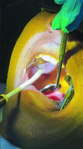 Watch us fill our patient's cavity! 🦷 #cavity #dentistry #dentist