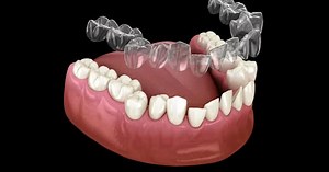 3D Animation of Teeth Alignment with Clear Aligners