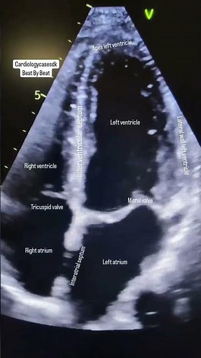 Standard 4-Chamber View Echocardiography, A Window to the Heart.