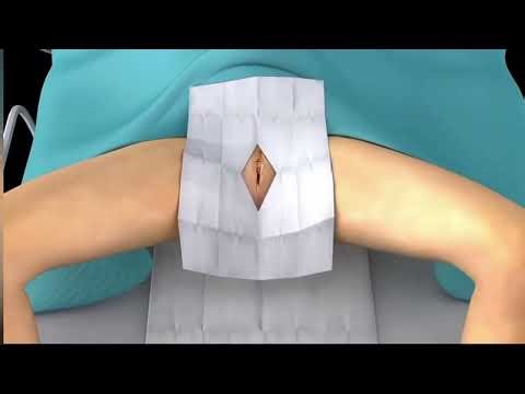 Female catheterization procedure #female #viral