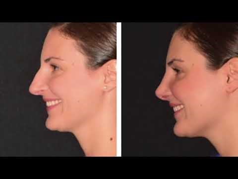 Rhinoplasty Before & After Compilation