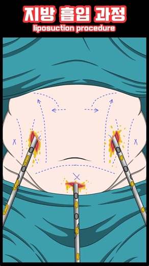 How Liposuction Works | Fat Removal Surgery Explained (Animated)