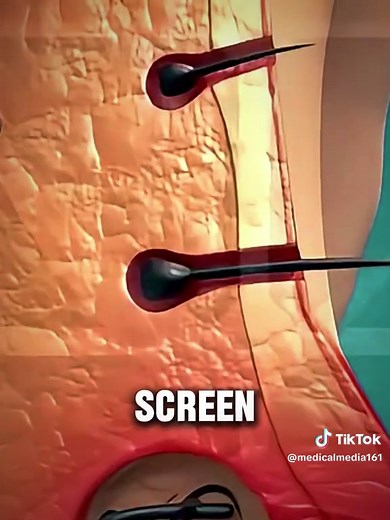 How Endoscopic Surgery Removes a Pilonidal Cyst? #pilonidalcyst #endoscopicsurgery #medicalfacts #pilonidalsinus #cyst #medical3danimation #medicalanimation