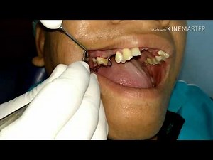Pencabutan Geraham Atas|Cabut Gigi Atas|Tooth Extraction