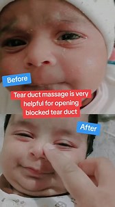 158K views · 731 reactions | Tear duct massage is very helpful for opening blocked tear duct #blockedtearduct #tearduct #ductmassage | Moms and minis | Facebook