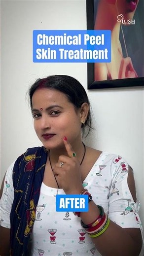 Melasma Treatment Results | Chemical Peel Before & After | Pigmentation Removal by Dr. Mudasir Khan