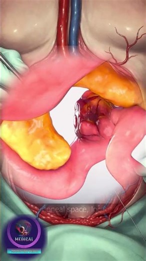 The Art of the Reconnect: Duodenal Tumor Removal