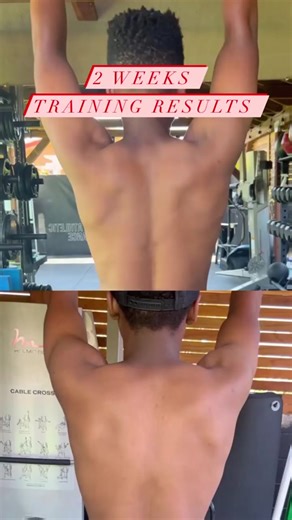 Understanding Scapular Winging: Corrective Exercises and Results