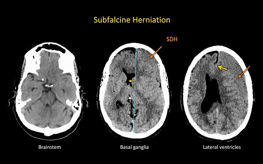 颅内占位效应及脑疝的影像及基础（Intracranial Mass Effect and Brain Herniation Made Easy）