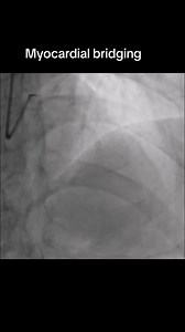 14K views · 200 reactions | Keadaan myocardial bridging. Keadaan ini berlaku dari lahir lagi. Sebahagian daripada saluran darah arteri koronari yang lalu di permukaan jantung terbenam dalam otot jantung. Apabila jantung mengepam, bahagian yang terbenam ini akan ditekan hingga sempit. Keadaan ini tidak menyebabkan serangan sakit jantung tetapi antara simptom myocardial bridging ini termasuk sakit dada. | Dr. Muhammad Imran bin Abdul Hafidz, Cardiologist | Facebook