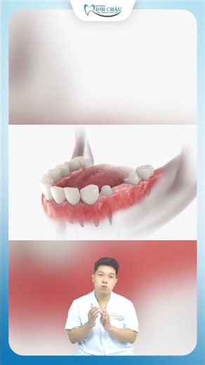 Advantages of Porcelain Bridges as a Replacement for Missing Teeth | Minh Chau Dental Clinic