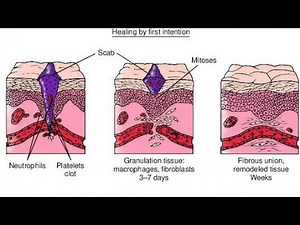 Healing by First Primary Intention (Wounds with Open Edges)