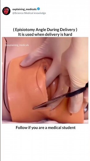 Episiotomy: A precise cut at the right angle can make delivery safer for both mother and baby.”👶