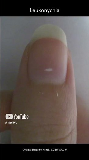 Leukonychia