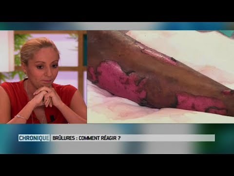 How to deal with burns - The Health Magazine