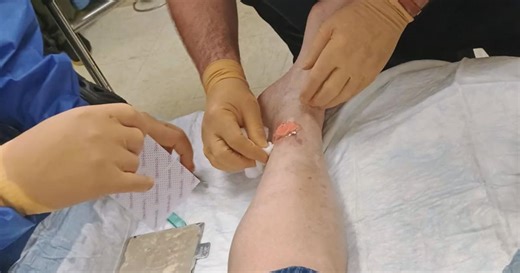 Made in Acadiana: Opelousas General Health System 3D tissue regeneration system helps burn patients
