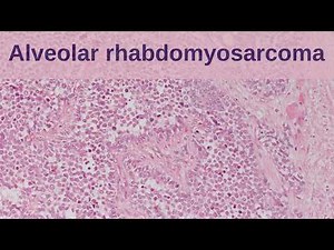 Alveolar Rhabdomyosarcoma - Pathology mini tutorials