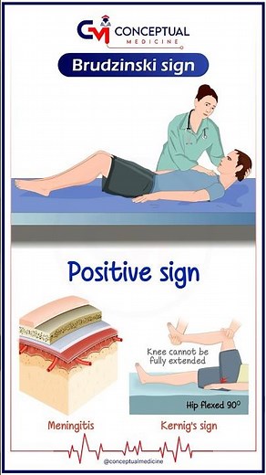 Brudzinski Sign Demonstration