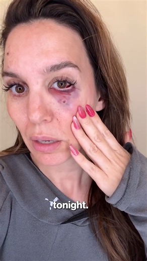 Yikes! 😳 Former Disney star Christy Carlson Romano nearly lost an eye while shooting clay pigeons with her husband, Brendan Rooney, for his birthday. "It was not fun," she said in the video, which sounds like the understatement of the century. https://trib.al/mQoeY8K | New York Post
