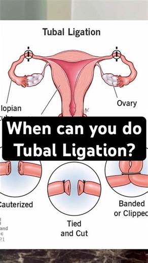 Tubal Ligation: When Can You Get It? ✅ Right after childbirth✅ During a C-section✅ When not pregnant
