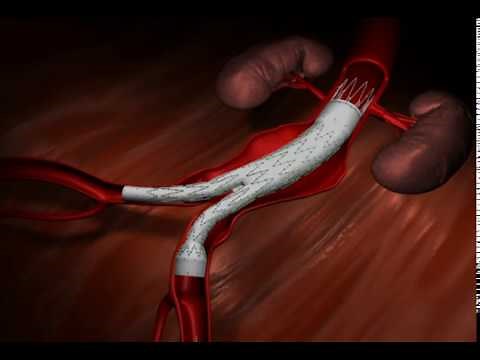 Endovascular Aortic Repair (EVAR)