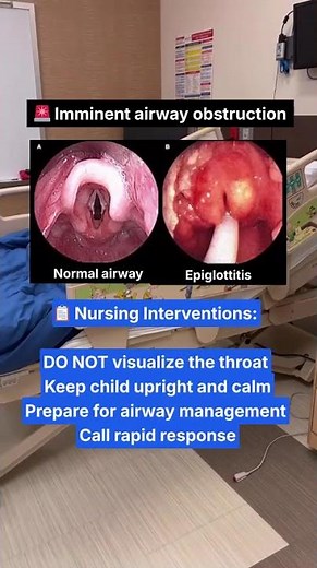 Epiglottitis = Airway Emergency 🚨