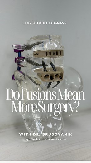 14 reactions | Thinking about a spinal fusion? 樂 Here’s what your surgeon might not tell you — it could mean more spine surgeries down the line  Dr. Brusovanik breaks down why this happens and what motion-preserving options exist instead   Call 305-467-5678 to schedule a consultation and protect your spine’s future 領✨ | Georgiy Brusovanik | Facebook